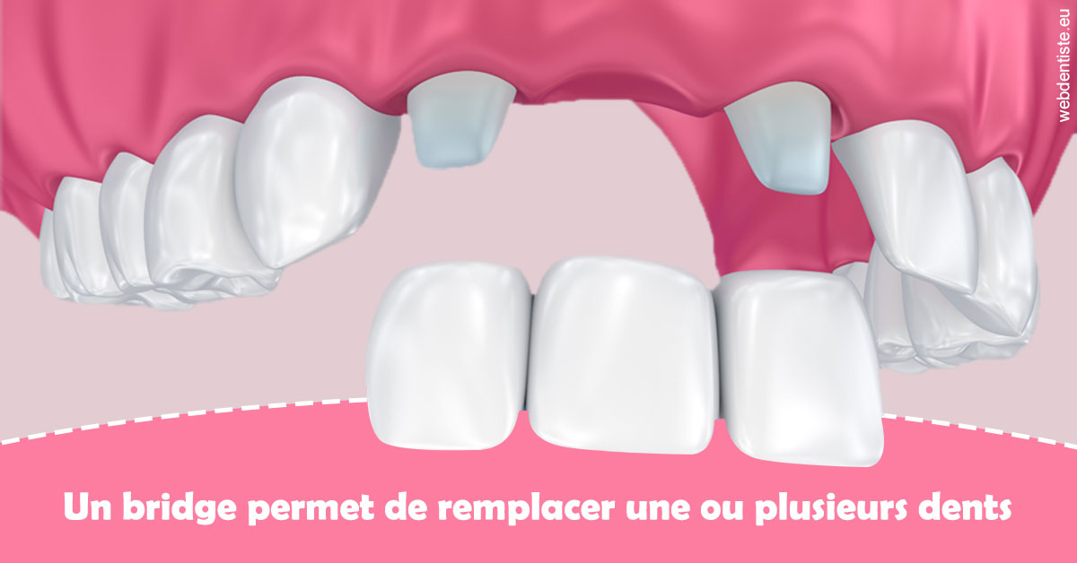 https://www.dr-amar.fr/Bridge remplacer dents 2