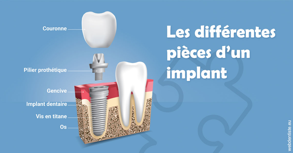https://www.dr-amar.fr/Les différentes pièces d’un implant 1